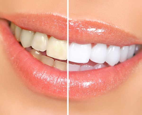 Teeth whitening Grand Rapids MI cosmetic dentists